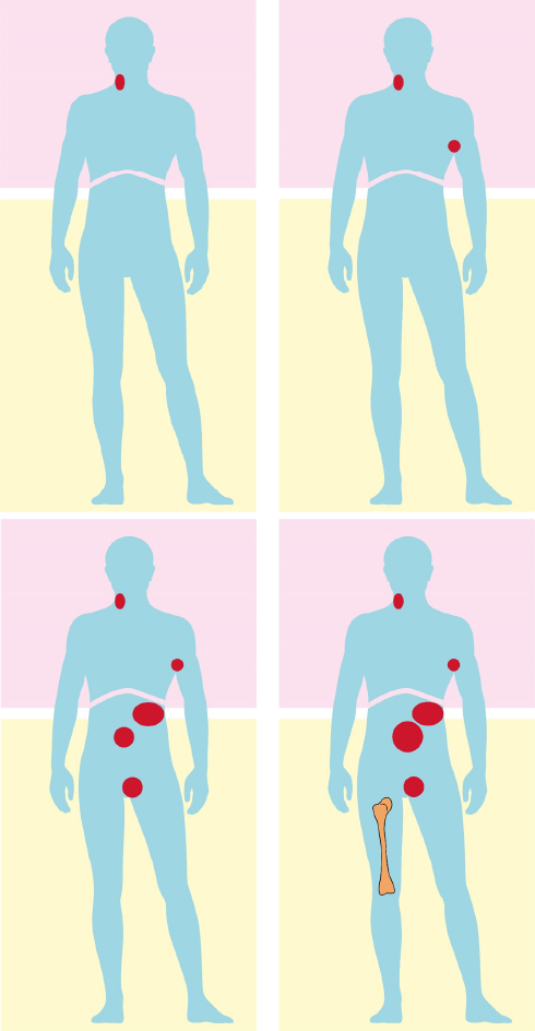 Illustration of the different stages of lymphoma